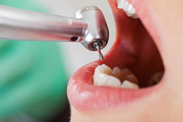 Best Dentist for Tooth Abscess  in Statesville, NC